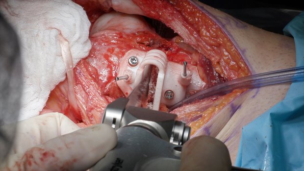 Derotational Medial Closing Wedge DFO, TTO, and MQTFL Reconstruction ...