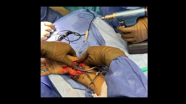 Distal Radius Fractures: When to Go From the Front or the Back | Vumedi