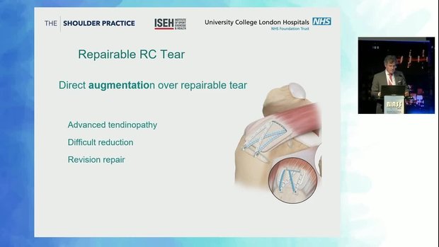 Rotator Cuff Tears: Spectrum of Graft Augmentation | Vumedi