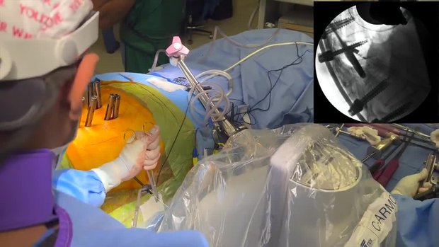 Prone Lateral Corpectomy Surgical Technique | Vumedi