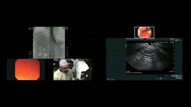 Live Case Demonstration: EUS Directed Transgastric ERCP (EDGE) | Vumedi
