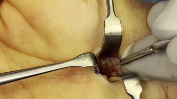 健康・医学 Wide Awake Hand Surgery and Therapy Tips 0d8cb0c0-aff4-4a1b-92ee-