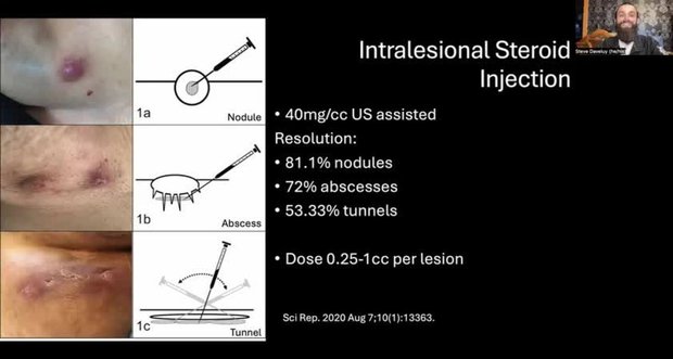 Intralesional Triamcinolone Injection for HS | Vumedi