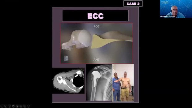 Tips and Tricks for Successful Total Shoulder Arthroplasty | Vumedi