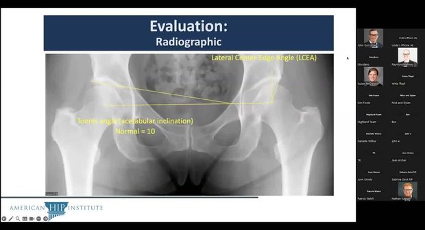 Femoro-Acetabular Impingement (FAI): Accuracy in Treatment | Vumedi