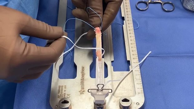 Endobutton for Proximal Fixation for Grafts of Different Source | Vumedi