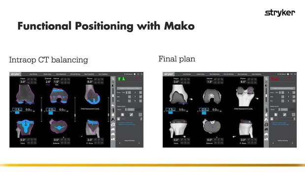 How is Functional Knee Positioning™ with Mako Different from ...