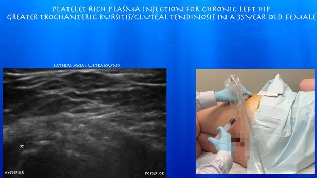 Platelet Rich Plasma Injection for Chronic Left Hip Greater ...