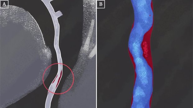 Understanding the Coronary CTA Report: CAD-RADS | Vumedi