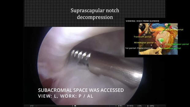 Arthroscopic Suprascapular Nerve Decompression | Vumedi