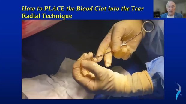 bpc 157 meniscus repair Fibrin Blood Clot Augmentation of Meniscus Repairs