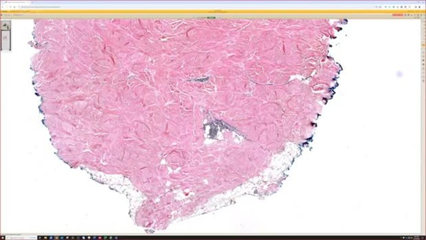 Morphea Skin Disease (Localized Scleroderma) Histology Pathology ...