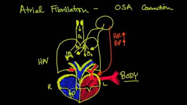 The Atrial Fibrillation and Obstructive Sleep Apnea Connection | Vumedi