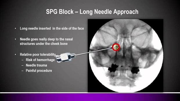 Sphenopalatine Ganglion Blockade | Vumedi