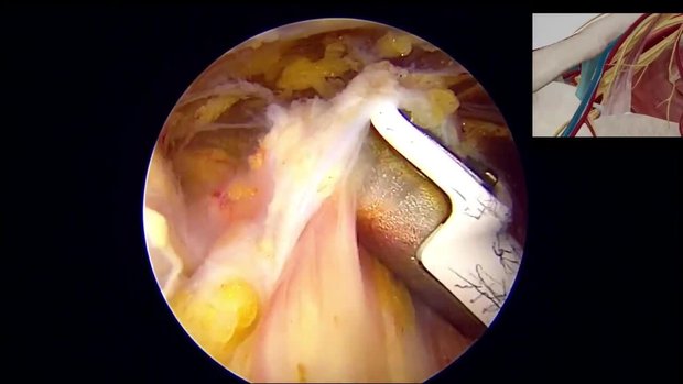 Suprascapular Nerve Arthroscopic Decompression | Vumedi