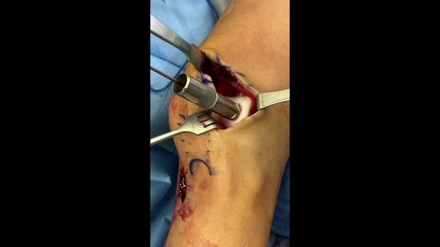 Treatment of an Osteochondral Defect of the Trochlea Utilizing  Matrix-Induced Autologous Chondrocyte Implantation and Proximal Tibia  Autologous Bone Grafting
