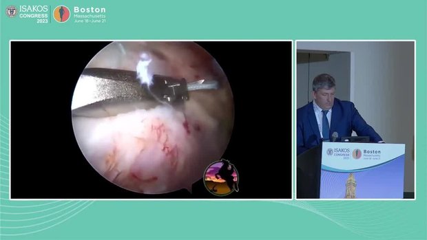 Arthroscopic Repair of L Shape and Reverse L Tears | Vumedi