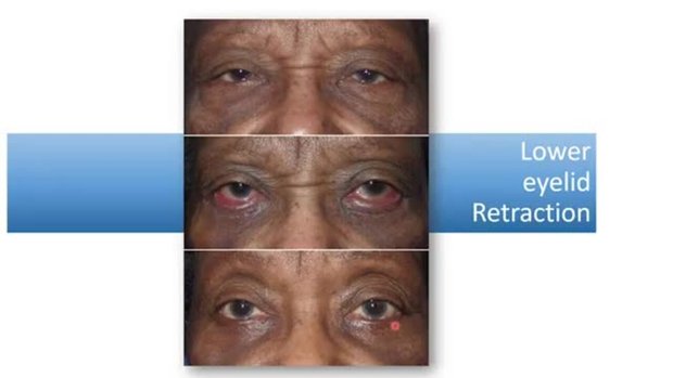 Common Complications After Cosmetic Blepharoplasty Surgery