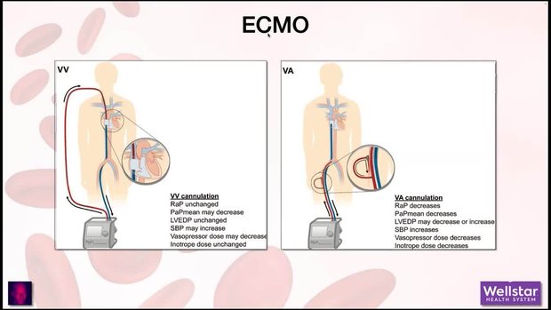 Temporary Mechanical Circulatory Support (MCS) Devices | Vumedi