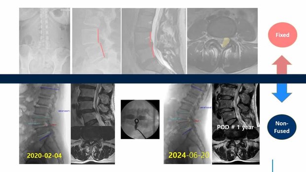 Endoscopy for Degen Spondy Indicated for Fusion | Vumedi