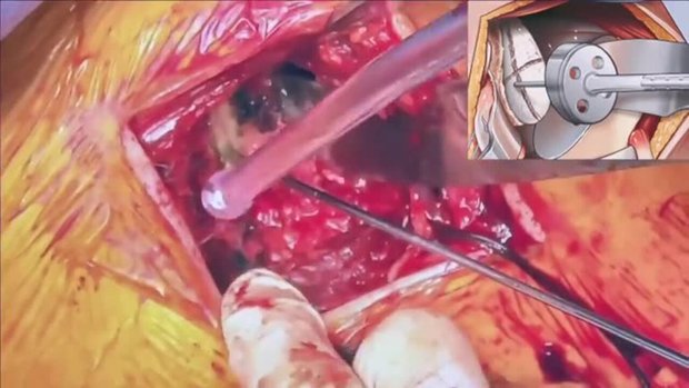 Bio-RSA Surgical Technique | Vumedi
