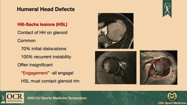 How Does Bone Loss Affect Instability in Athletes | Vumedi