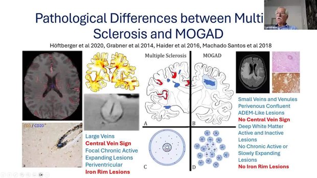 ECTRIMS 2024 Insights: Pathology of NMOSD, MOGAD and MS | Vumedi