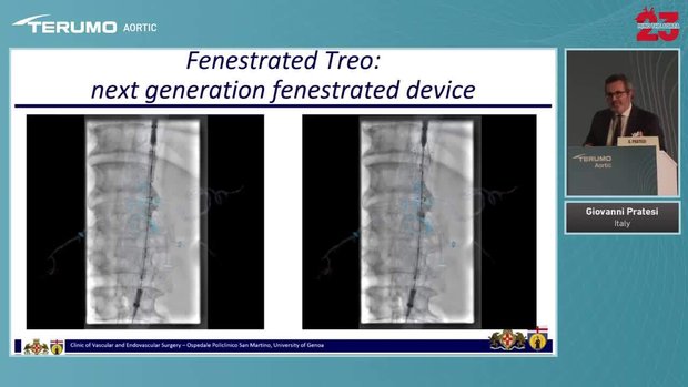 MTA 2023 - Next Generation Fenestrated Device: Fenestrated TREO | Vumedi