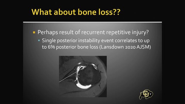Posterior Instability and Bone Loss: Management in the Athlete | Vumedi