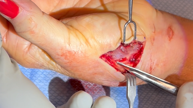 Wide Awake Hand Surgery: Thumb Basal Joint Arthroplasty | Vumedi
