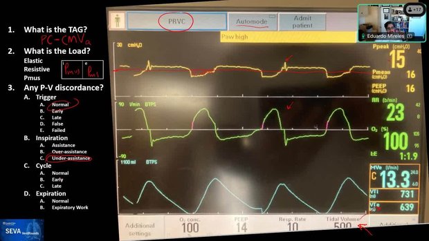 Working Against the Ventilator: Reading Waveforms | Vumedi
