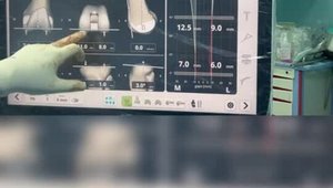 Flexion and Extension Gap Balancing in Robotic TKR: How to Get It Right ...