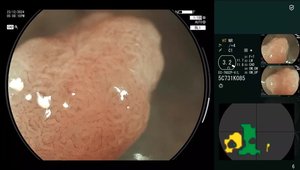 Artificial Intelligence in Detecting Colonic Polyps Using Fujifilm ...