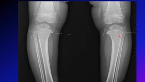 Blount's Disease (Tibia Vara): Pathology, Classification, Clinical ...
