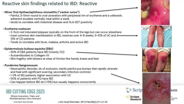 IBD and the Skin | Vumedi