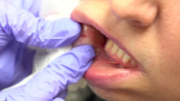 Labial Salivary Gland Biopsy Demonstration | Vumedi