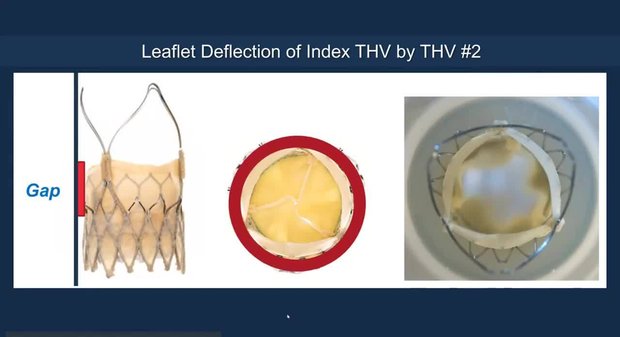 TAVI in TAVI: Current Evidence and How to Do It | Vumedi