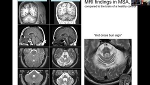 MSA Epidemiology & Diagnosis: What Is MSA and How to Diagnose? What Are ...