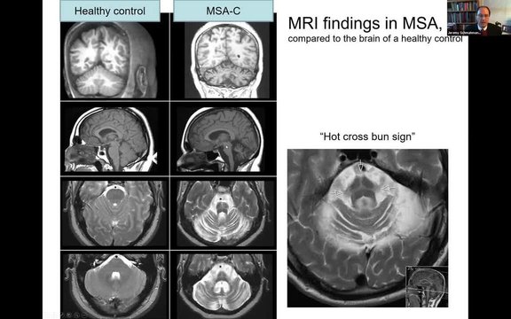 MSA Epidemiology & Diagnosis: What Is MSA and How to Diagnose? What Are ...