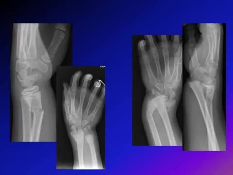 Wrist Fractures in Children: Different Types and How to Differentiate ...