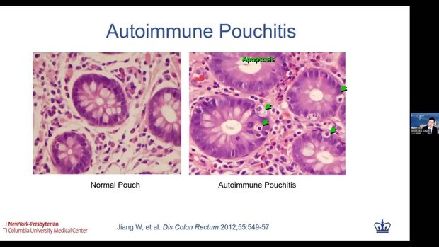 Pathogenesis of Pouchitis | Vumedi
