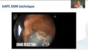Hybrid APC in EMR and Systemic Ablation of Margins and Defect | Vumedi