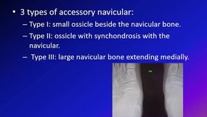 Accessory Navicular: Overview of the Pathology, XR and Treatment | Vumedi