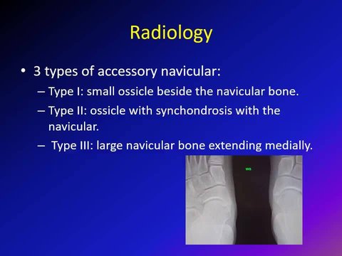 Accessory Navicular: Overview of the Pathology, XR and Treatment | Vumedi