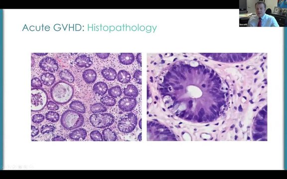 Management of Acute GVHD Associated With HSCT: Risk Factors, Clinical ...