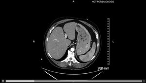 Acute GI Bleed CTA With IR Embolization vs. Urgent Endoscopy | Vumedi