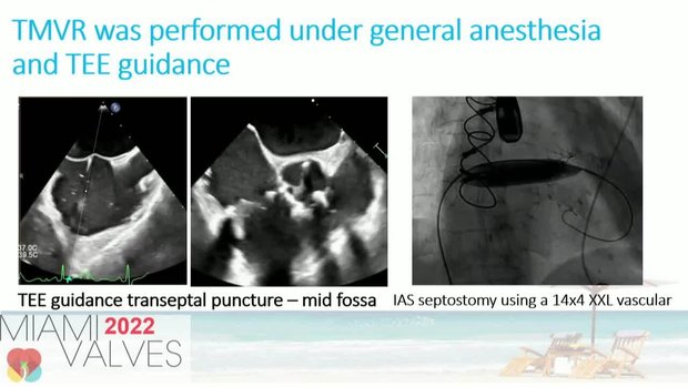 Simultaneous Transcatheter Mitral and Tricuspid Valve-in-Valve ...