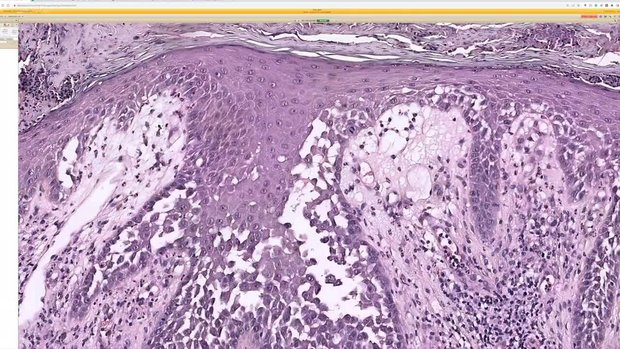 Dermatopathology Case Review: Hailey-Hailey Disease | Vumedi