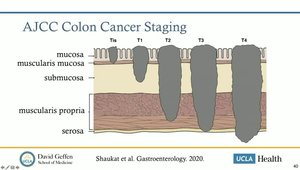 Assessment and Classification of Large Colon Polyps | Vumedi