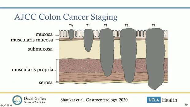 Assessment and Classification of Large Colon Polyps | Vumedi
